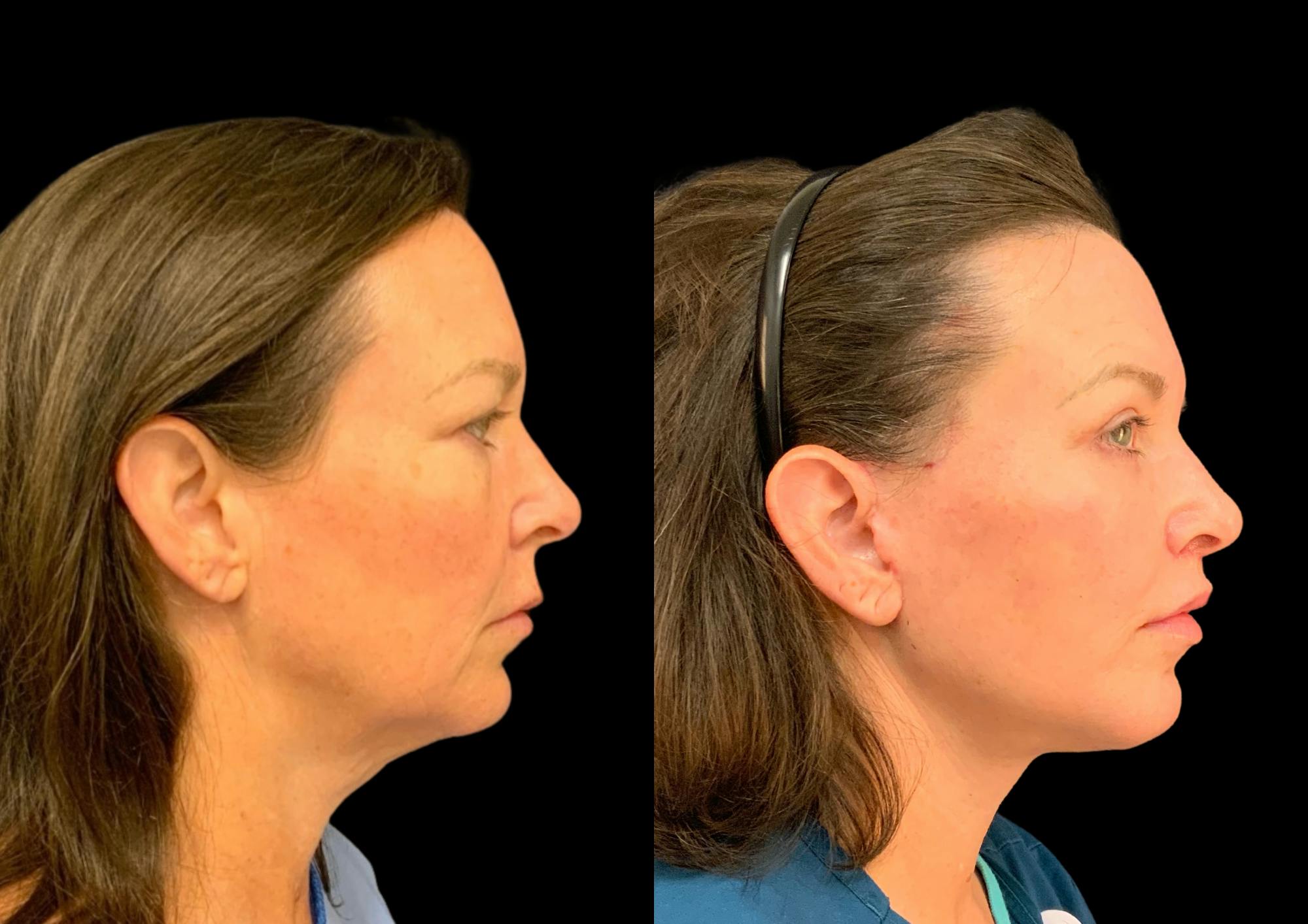 Upper Blepharoplasty Before & After Gallery - Patient 378839 - Image 5