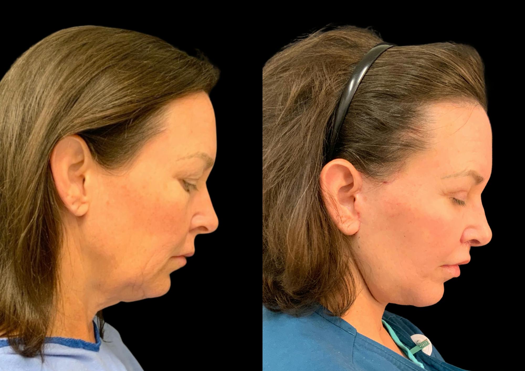 Facelift Before & After Gallery - Patient 211763 - Image 7