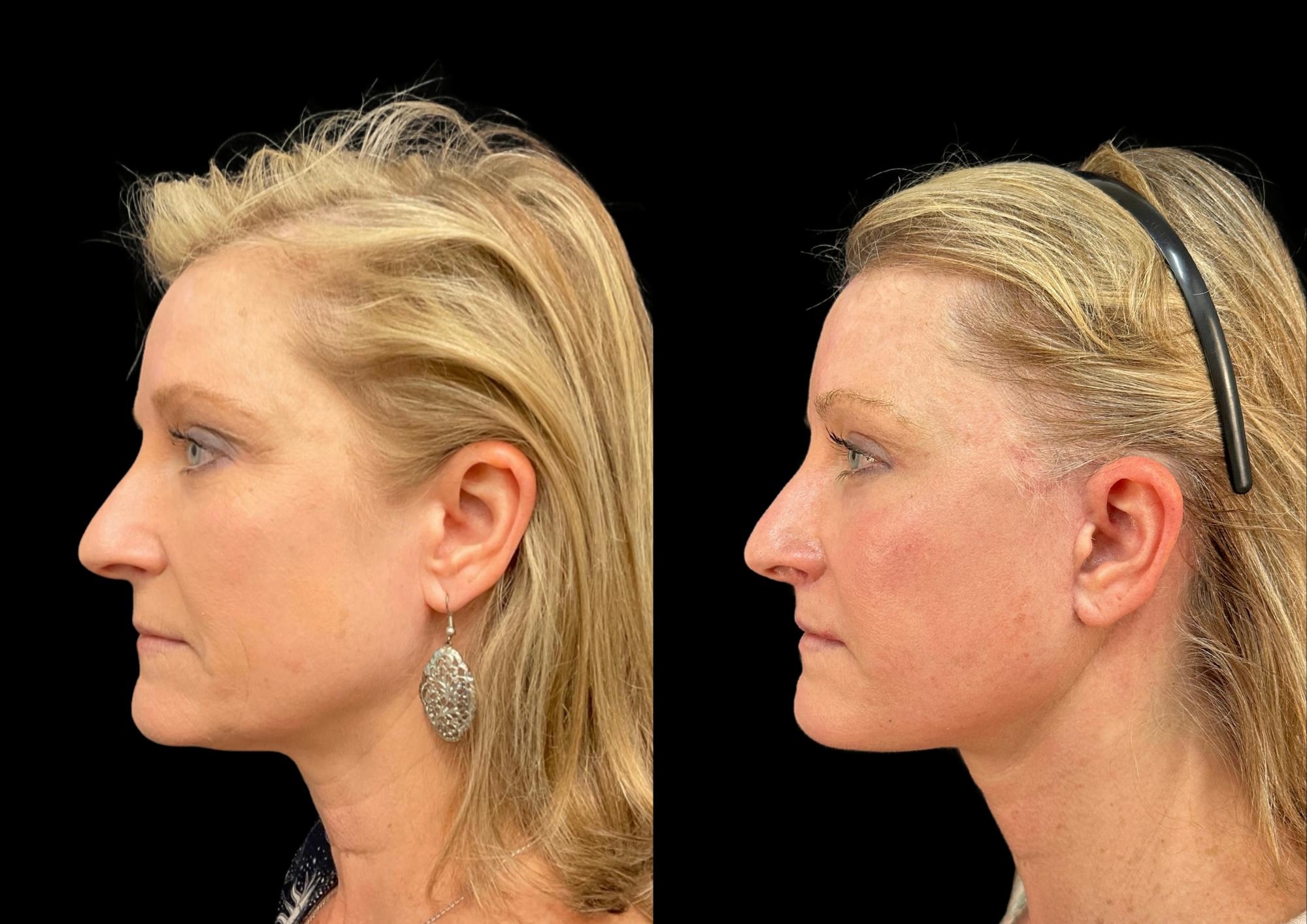Brow Lift Before & After Gallery - Patient 749520 - Image 3