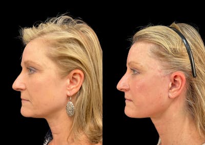 Neck Lift Before & After Gallery - Patient 306970 - Image 1