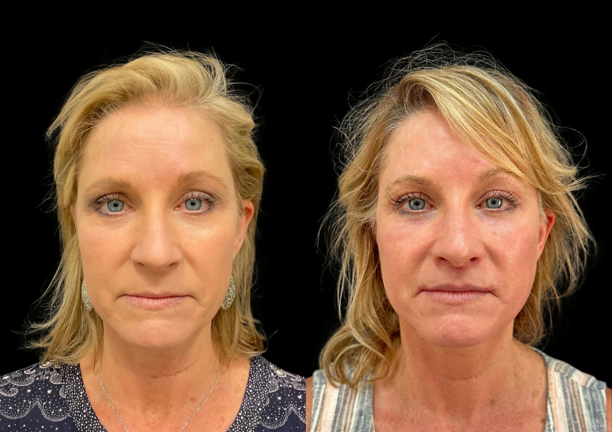 Brow Lift Before & After Gallery - Patient 749520 - Image 1