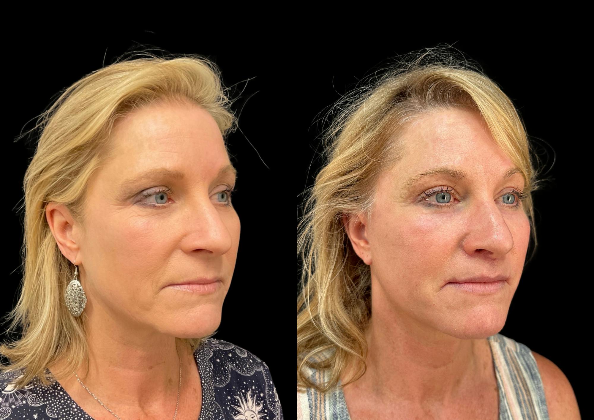 Brow Lift Before & After Gallery - Patient 749520 - Image 4