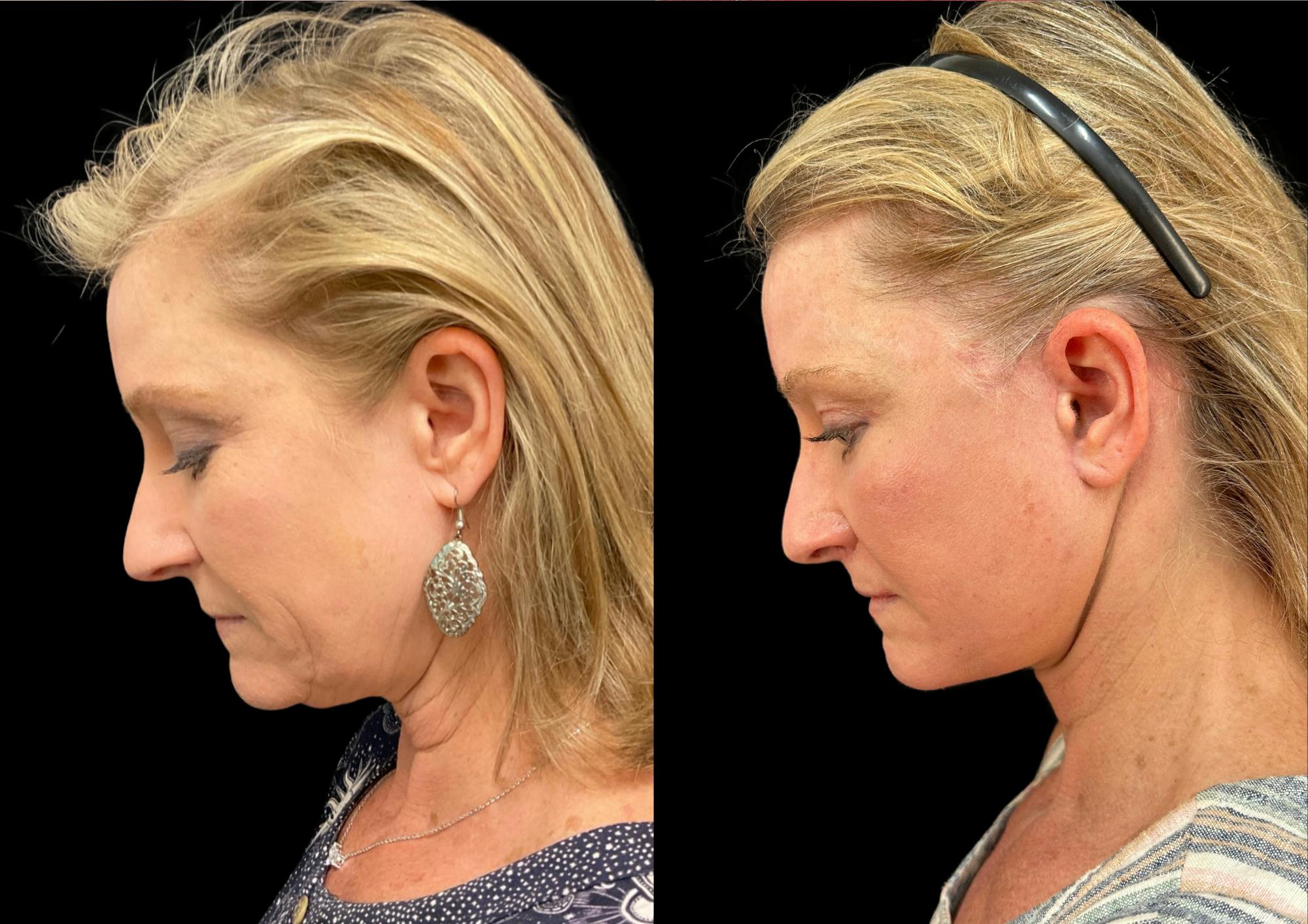 Neck Lift Before & After Gallery - Patient 306970 - Image 2