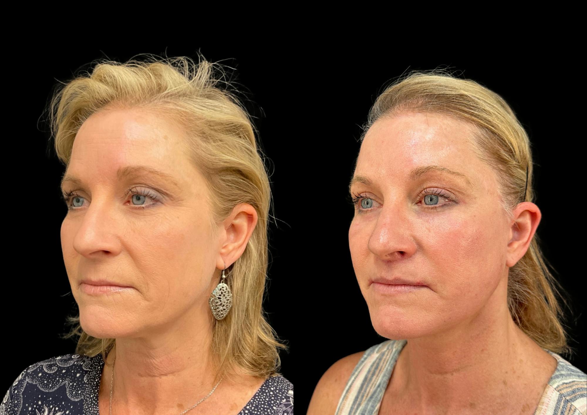 Brow Lift Before & After Gallery - Patient 749520 - Image 2