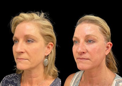 Facelift Before & After Gallery - Patient 253321 - Image 1