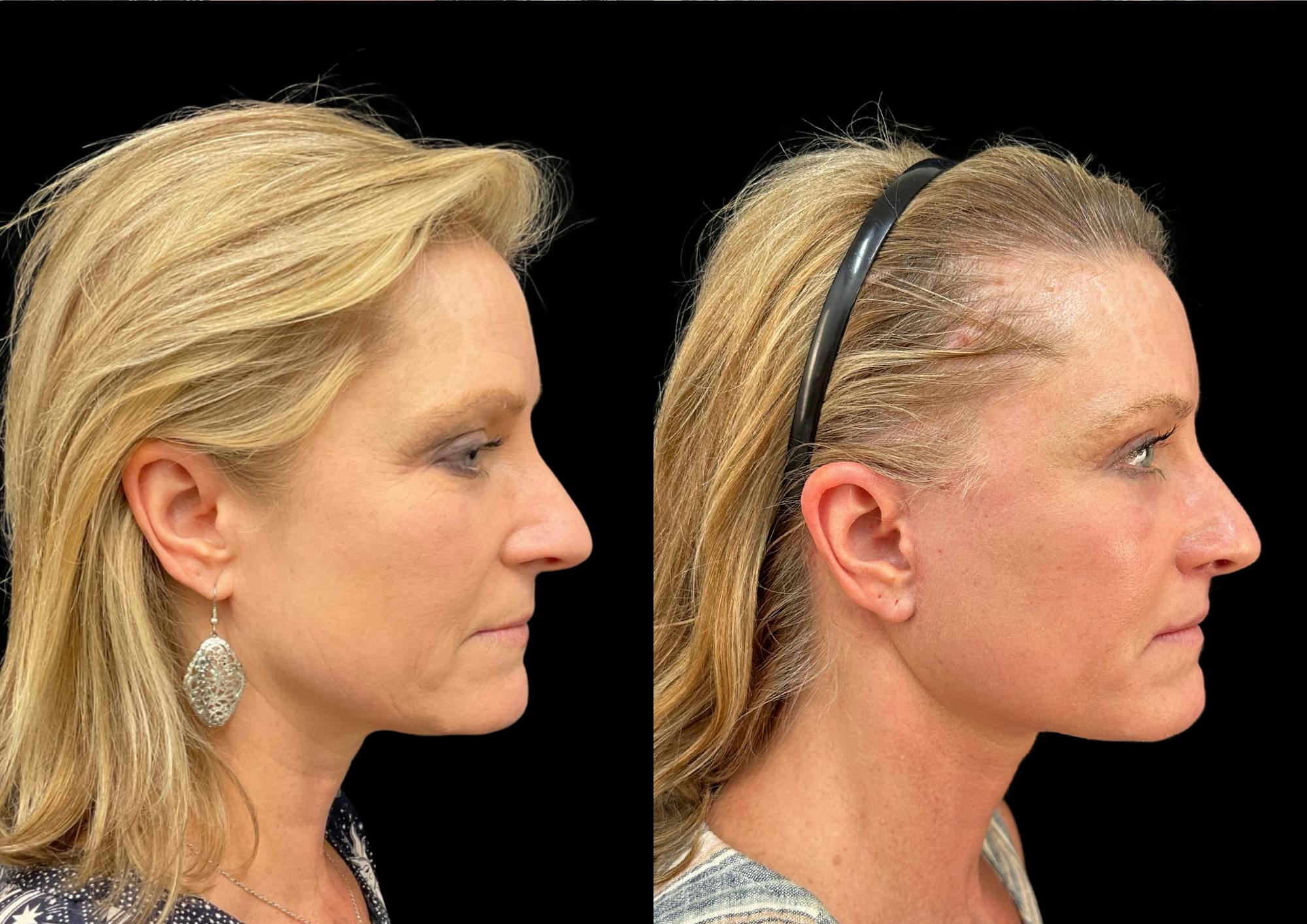 Brow Lift Before & After Gallery - Patient 749520 - Image 5
