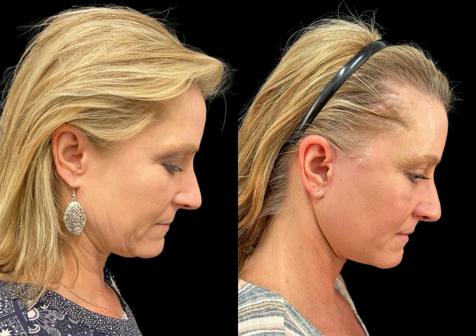Neck Lift Before & After Gallery - Patient 306970 - Image 7
