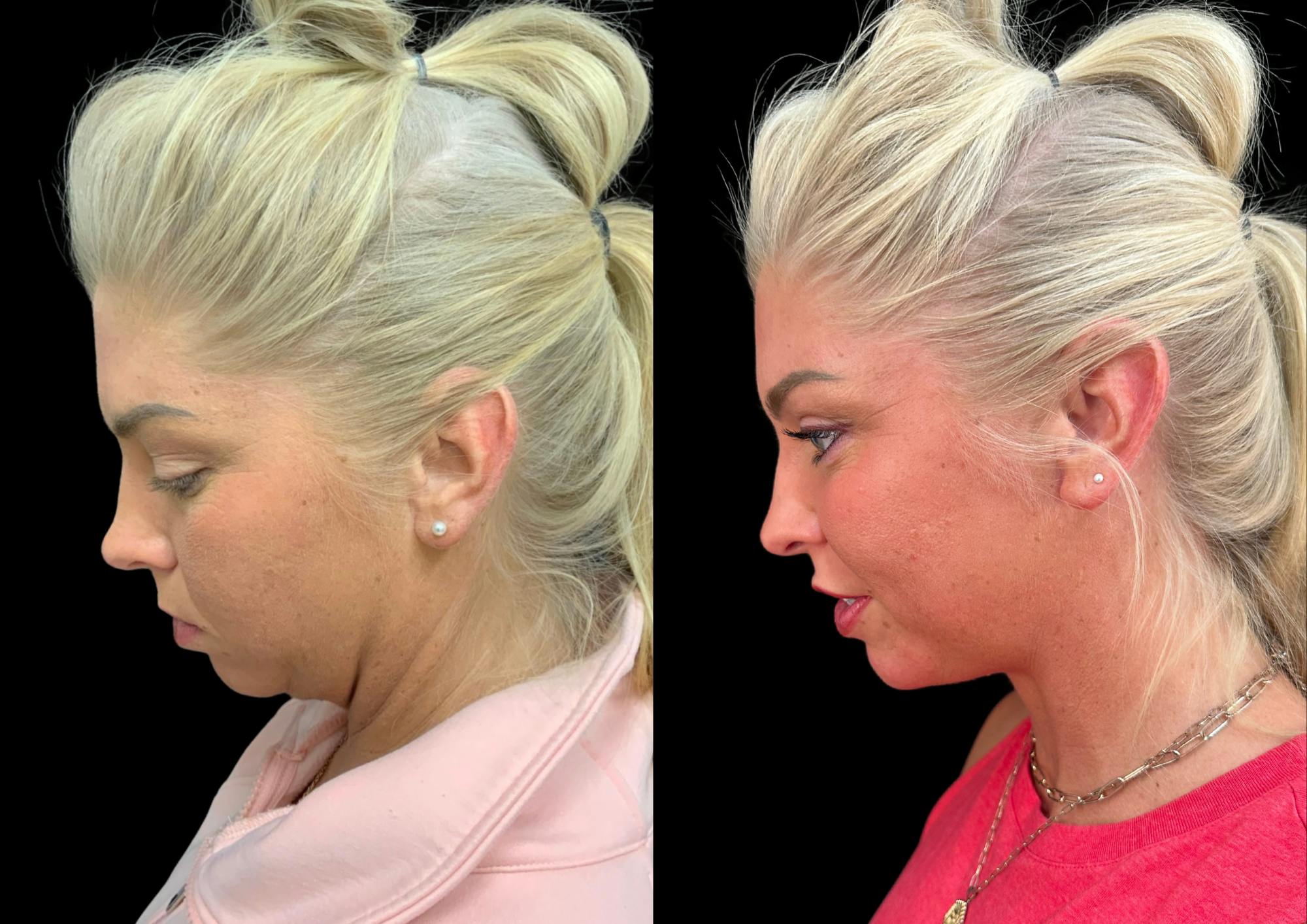 Neck Lift Before & After Gallery - Patient 843346 - Image 2