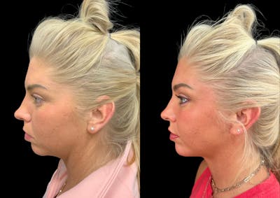 Neck Lift Before & After Gallery - Patient 843346 - Image 1