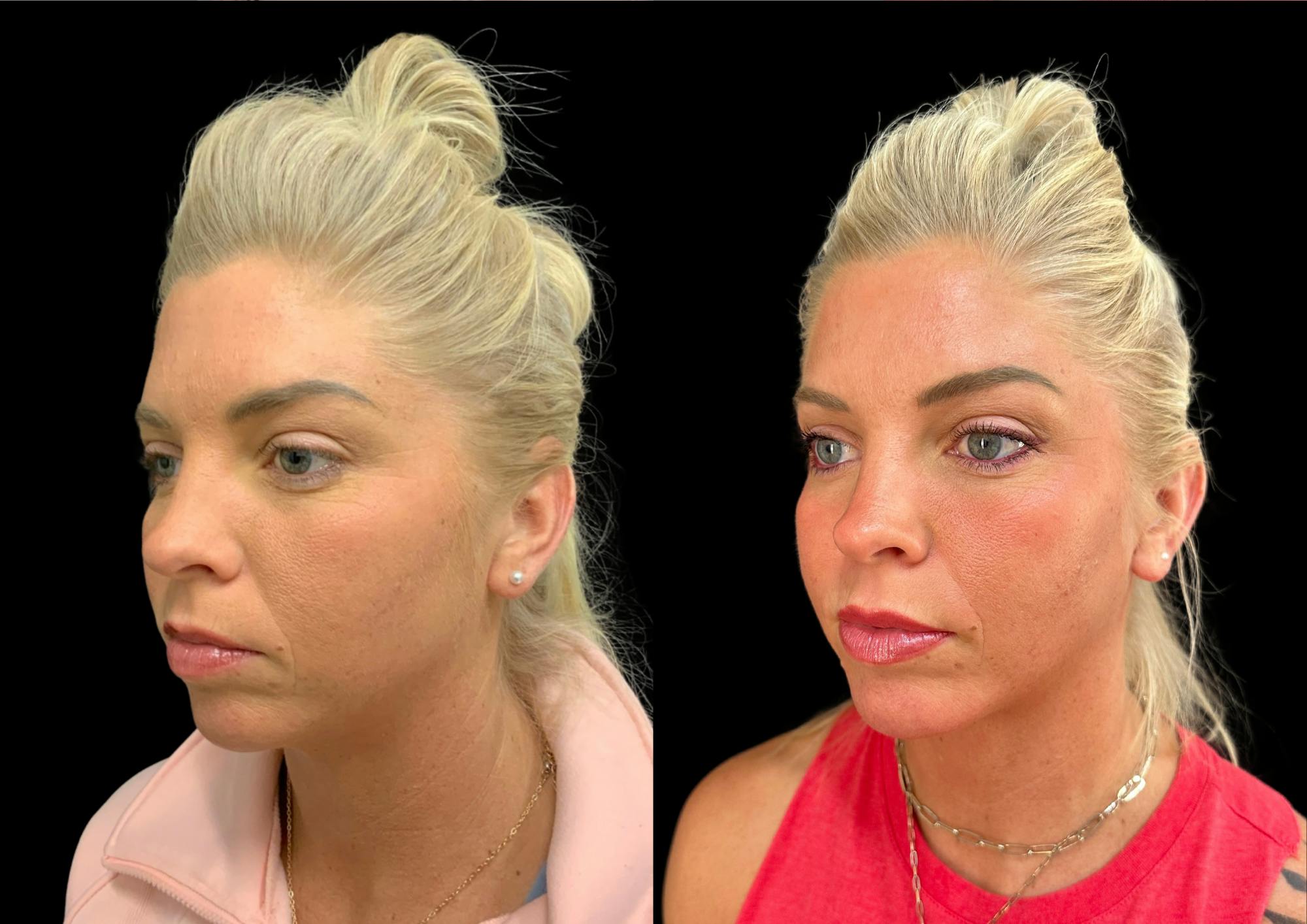 Neck Lift Before & After Gallery - Patient 843346 - Image 3