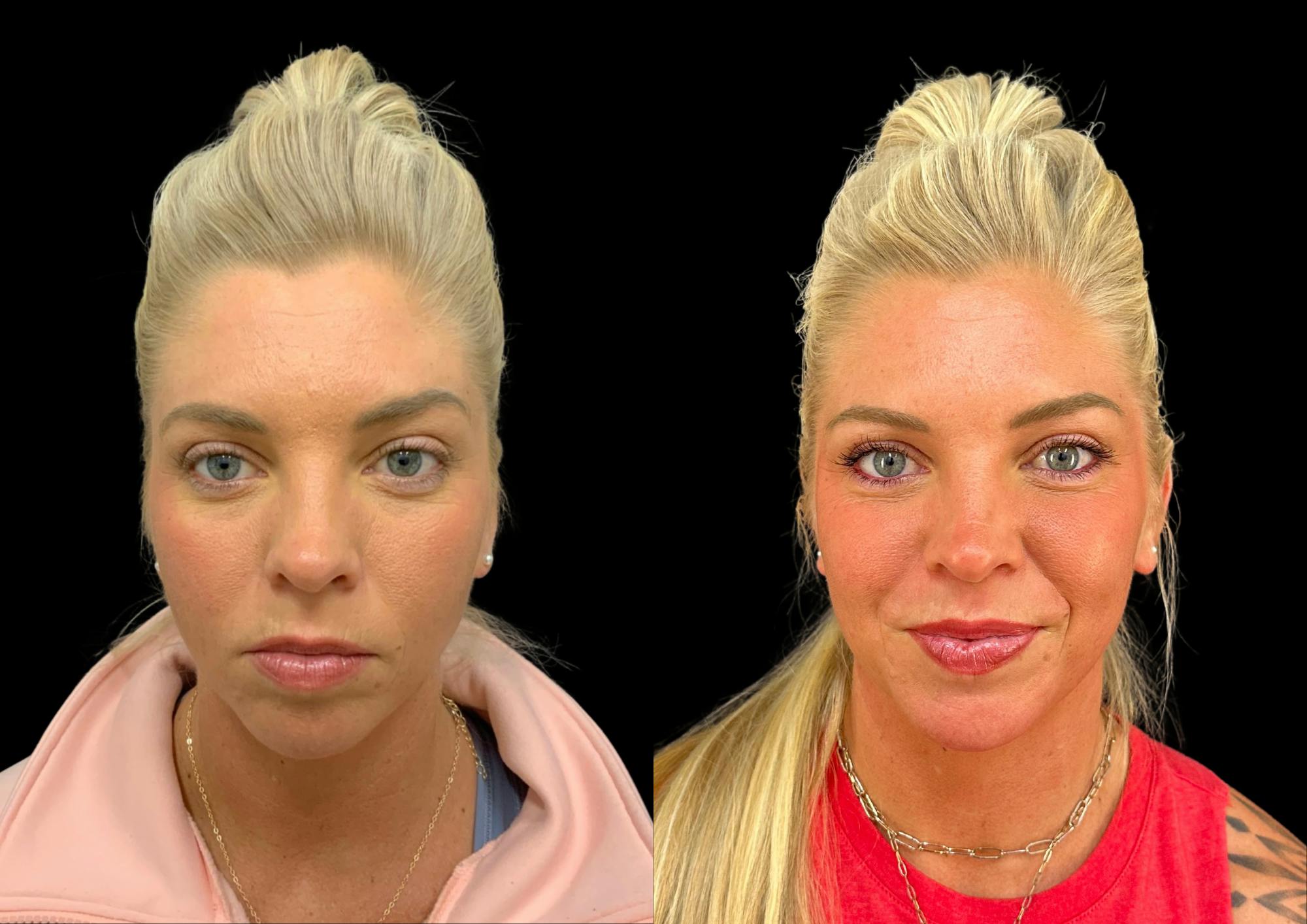 Neck Lift Before & After Gallery - Patient 843346 - Image 4