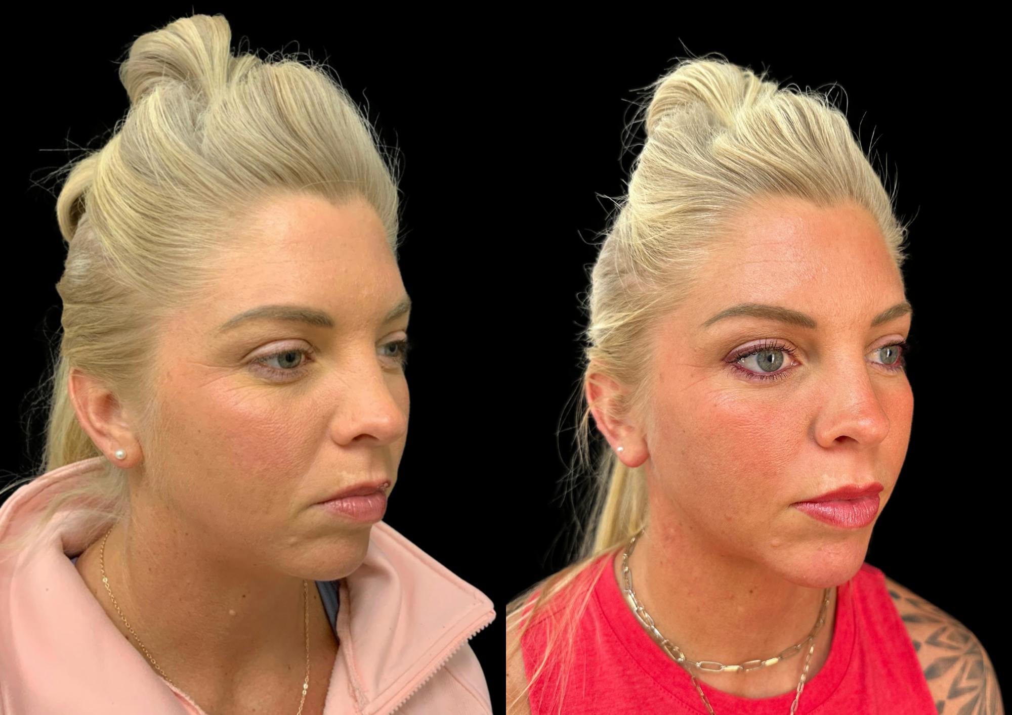 Neck Lift Before & After Gallery - Patient 843346 - Image 5