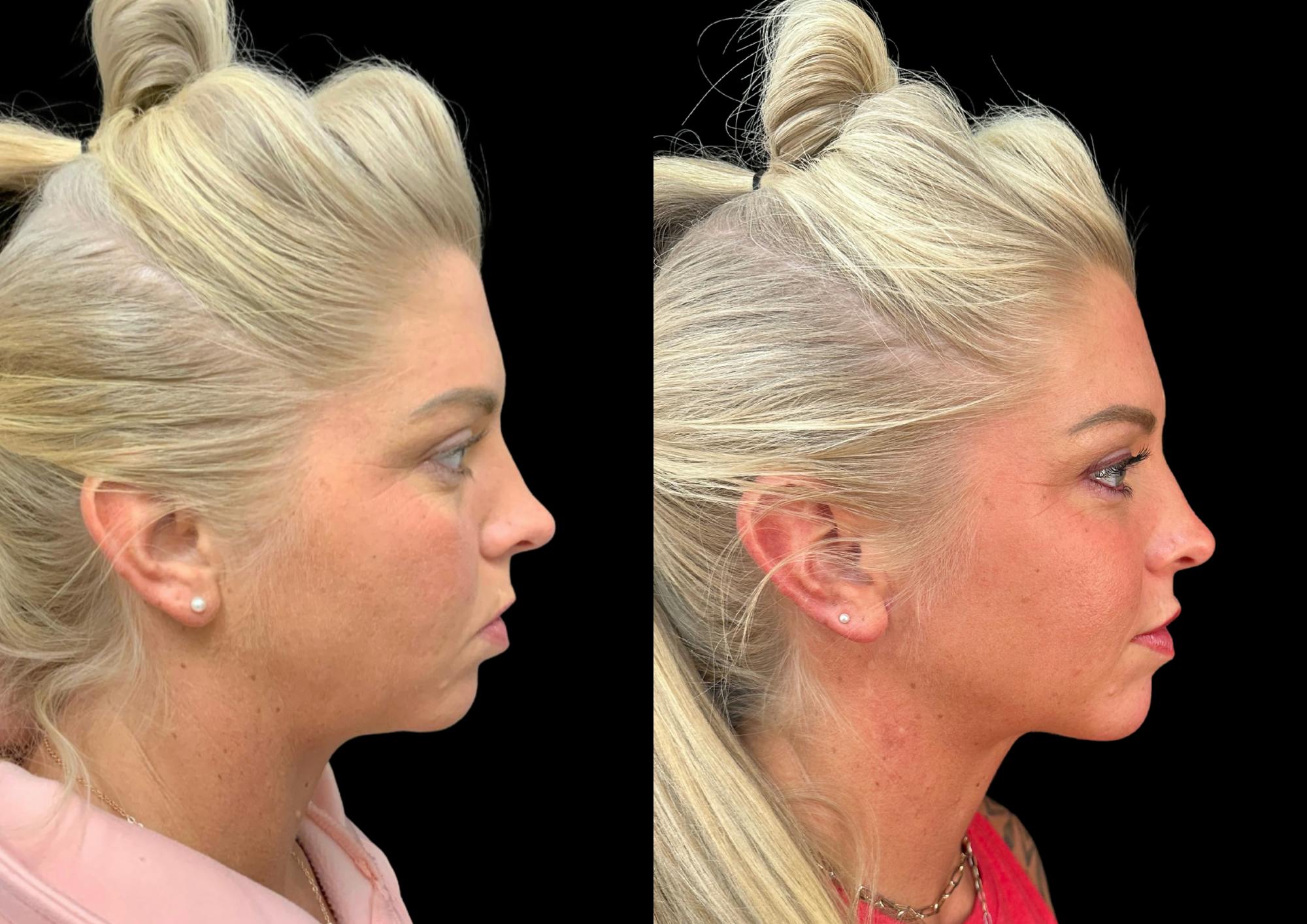 Neck Lift Before & After Gallery - Patient 843346 - Image 6
