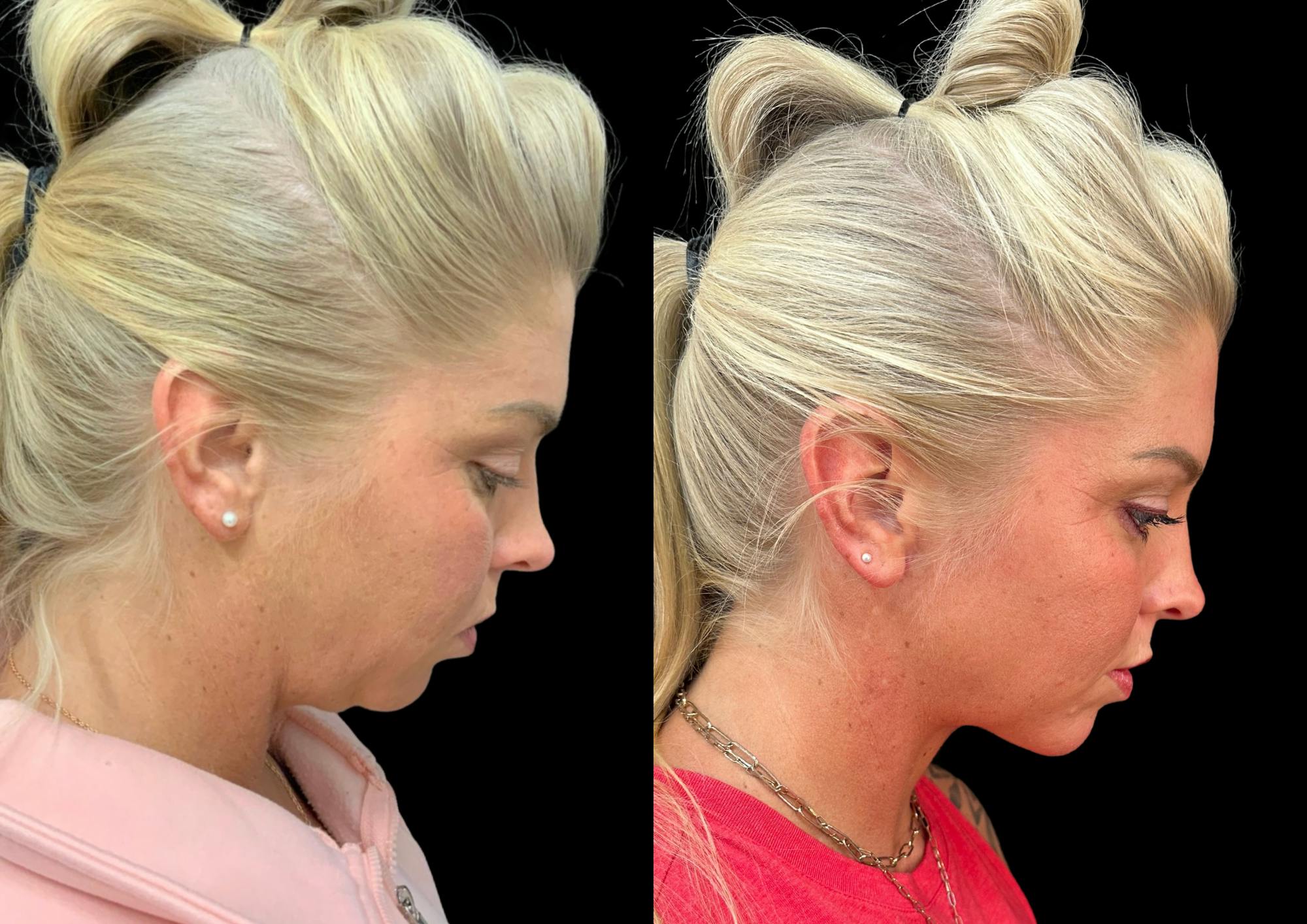 Neck Lift Before & After Gallery - Patient 843346 - Image 7