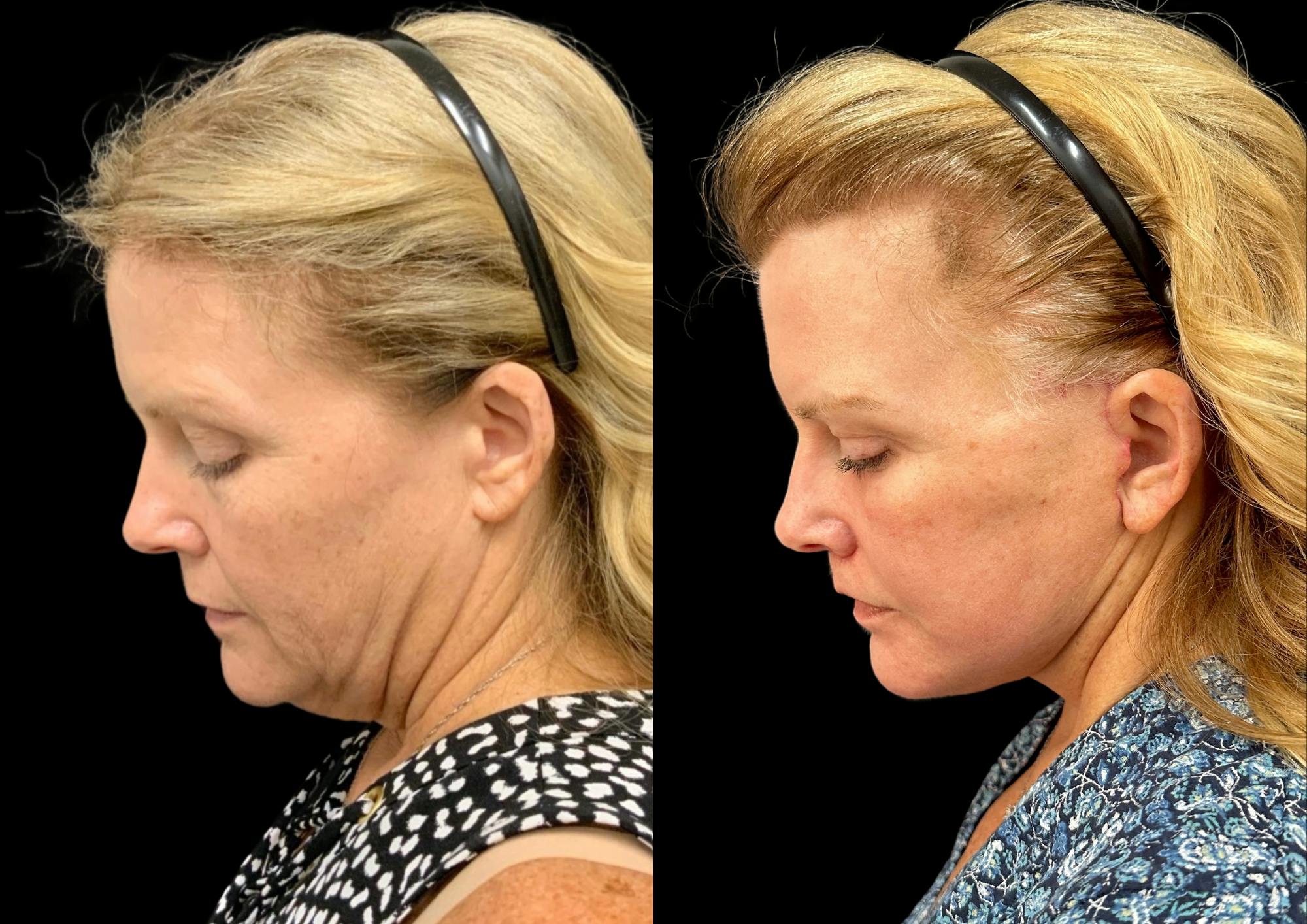 Facelift Before & After Gallery - Patient 317828 - Image 2