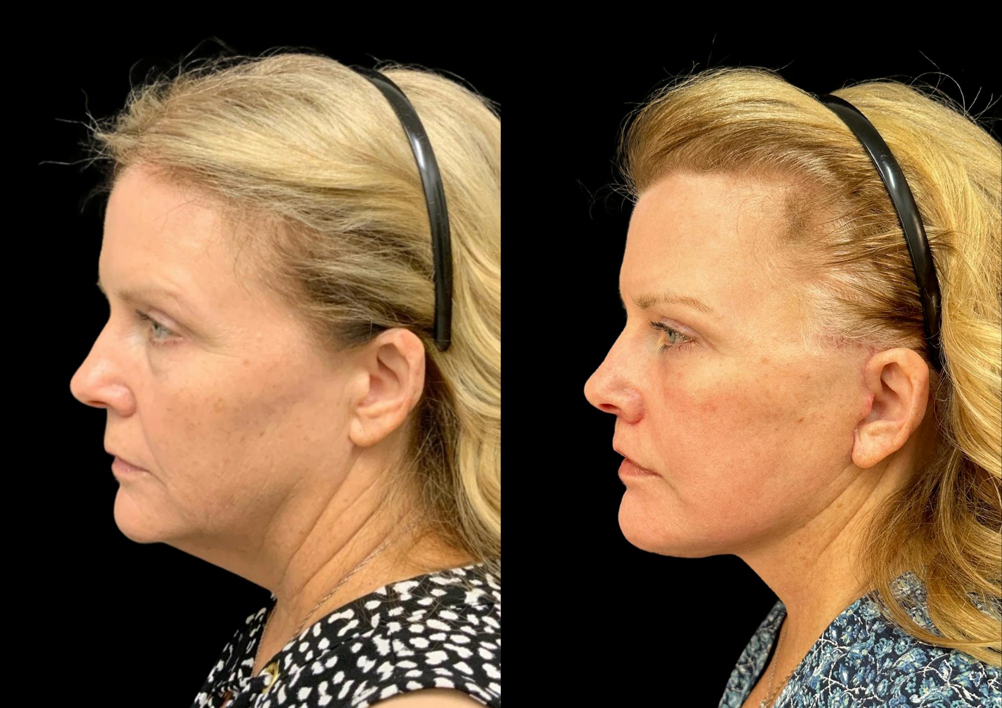 Facelift Before & After Gallery - Patient 317828 - Image 3
