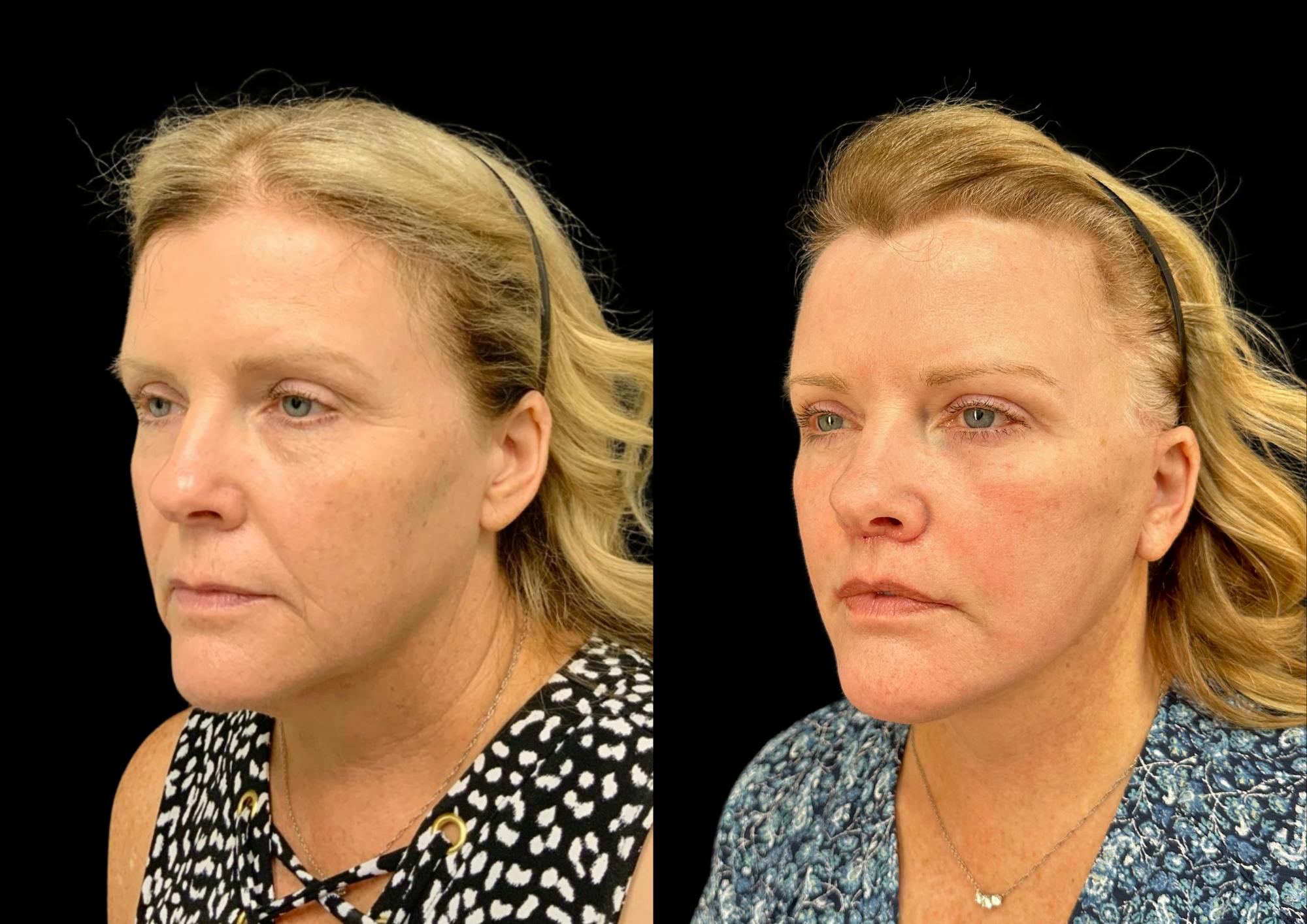 Facelift Before & After Gallery - Patient 317828 - Image 1