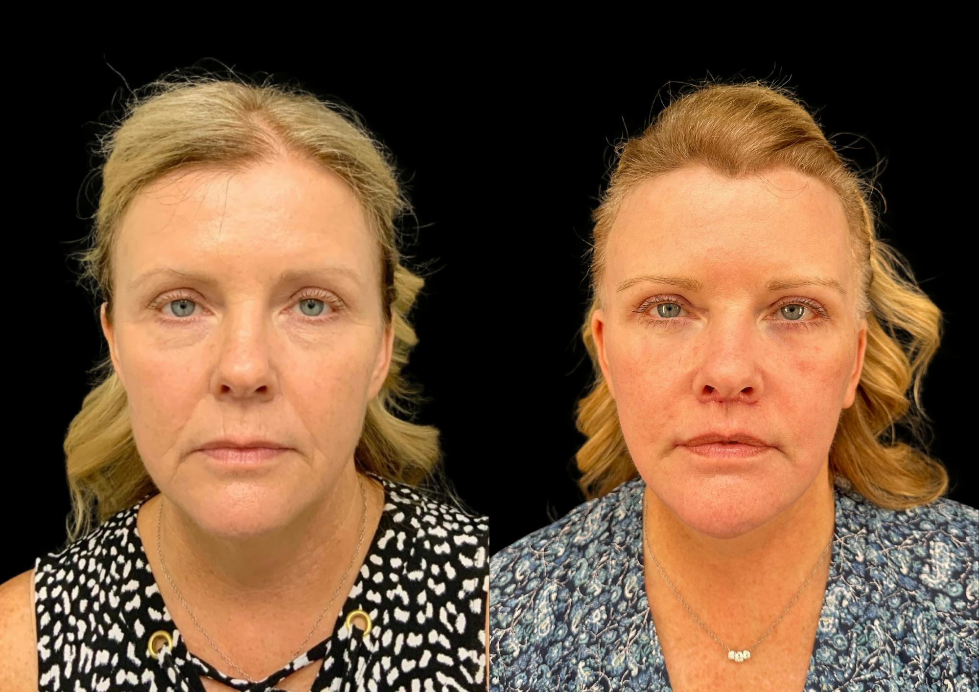 Facelift Before & After Gallery - Patient 317828 - Image 4