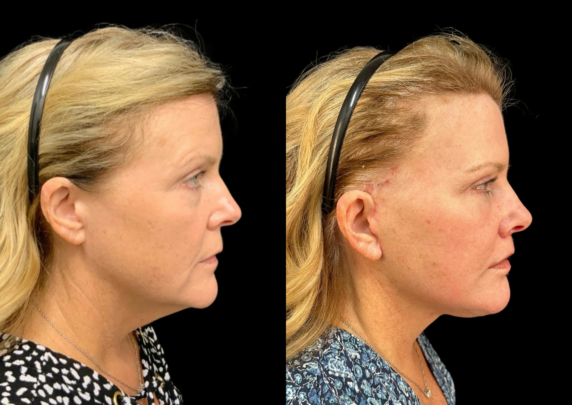 Facelift Before & After Gallery - Patient 317828 - Image 6