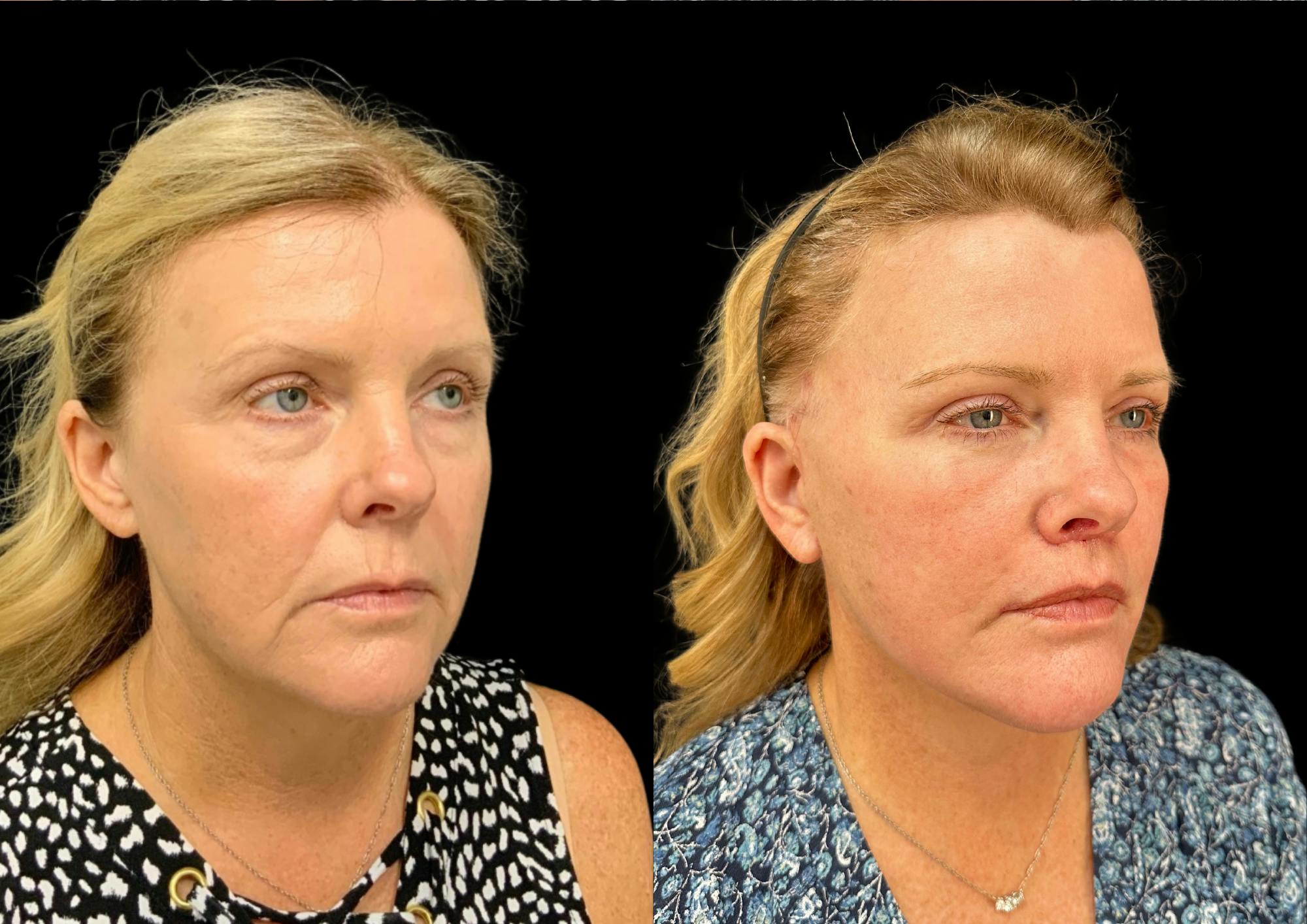 Facelift Before & After Gallery - Patient 317828 - Image 5