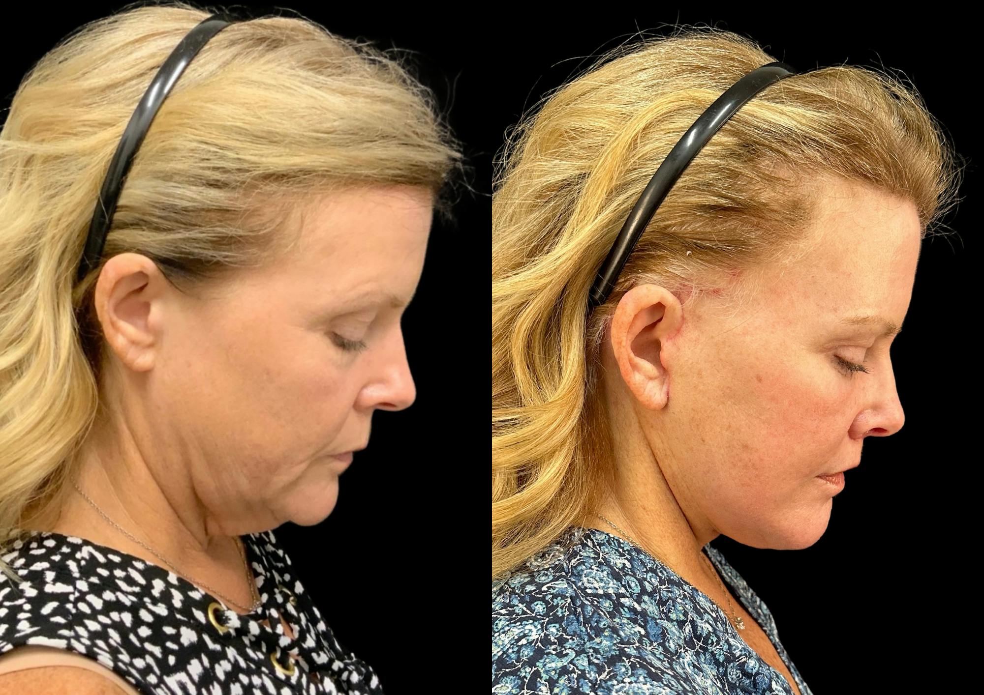 Facelift Before & After Gallery - Patient 317828 - Image 7