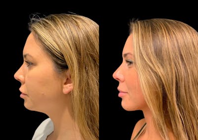 Neck Lift Before & After Gallery - Patient 347374 - Image 1