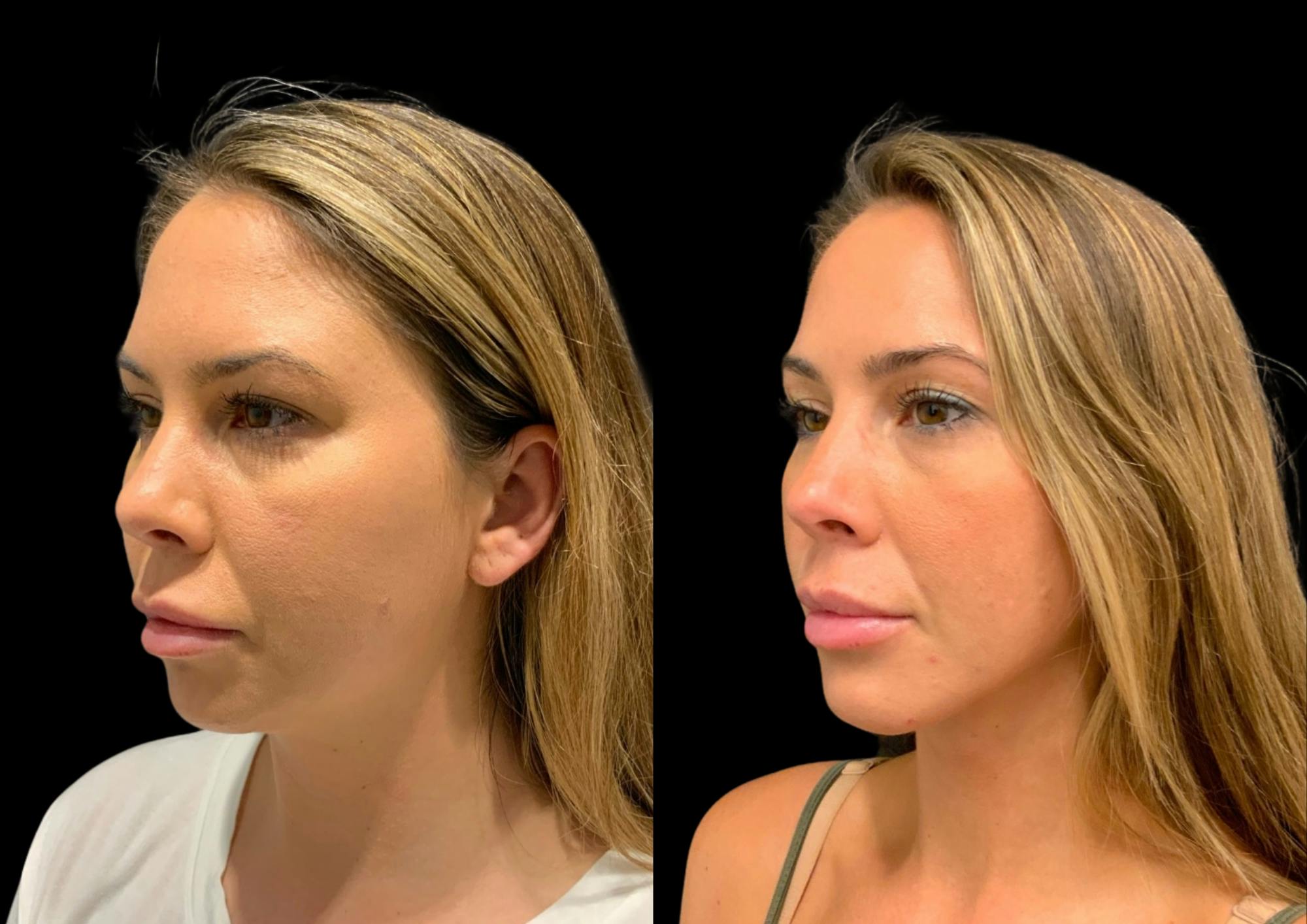 Neck Lift Before & After Gallery - Patient 347374 - Image 2