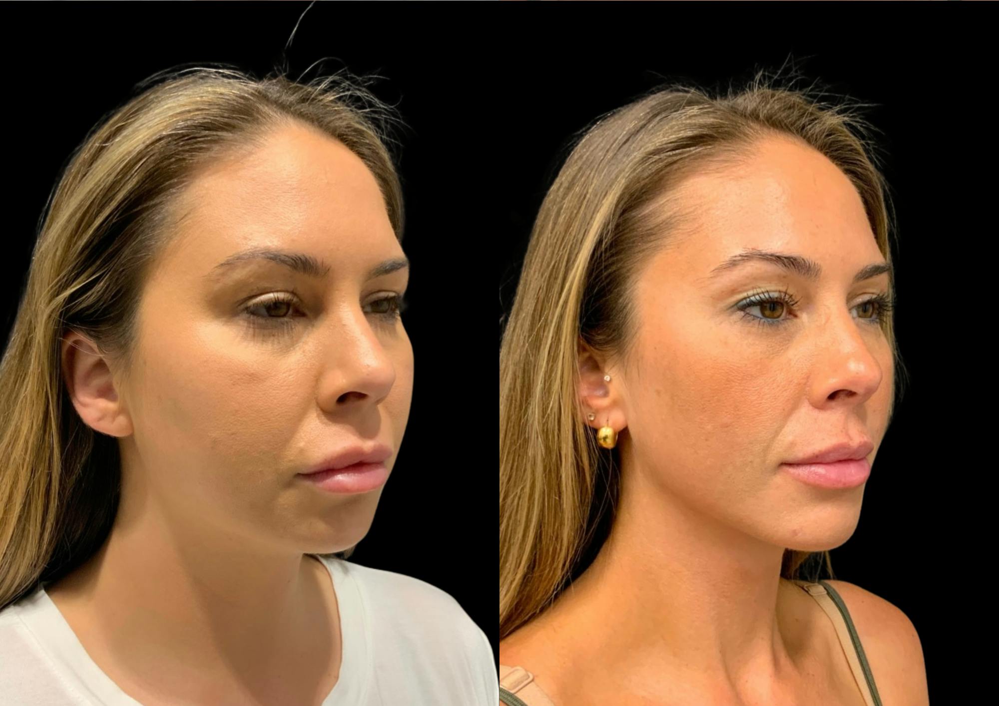 Neck Lift Before & After Gallery - Patient 347374 - Image 4