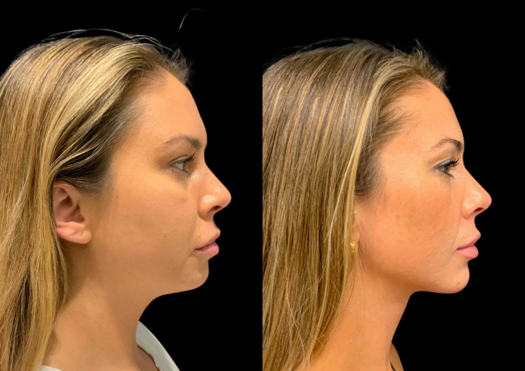 Neck Lift Before & After Gallery - Patient 347374 - Image 5