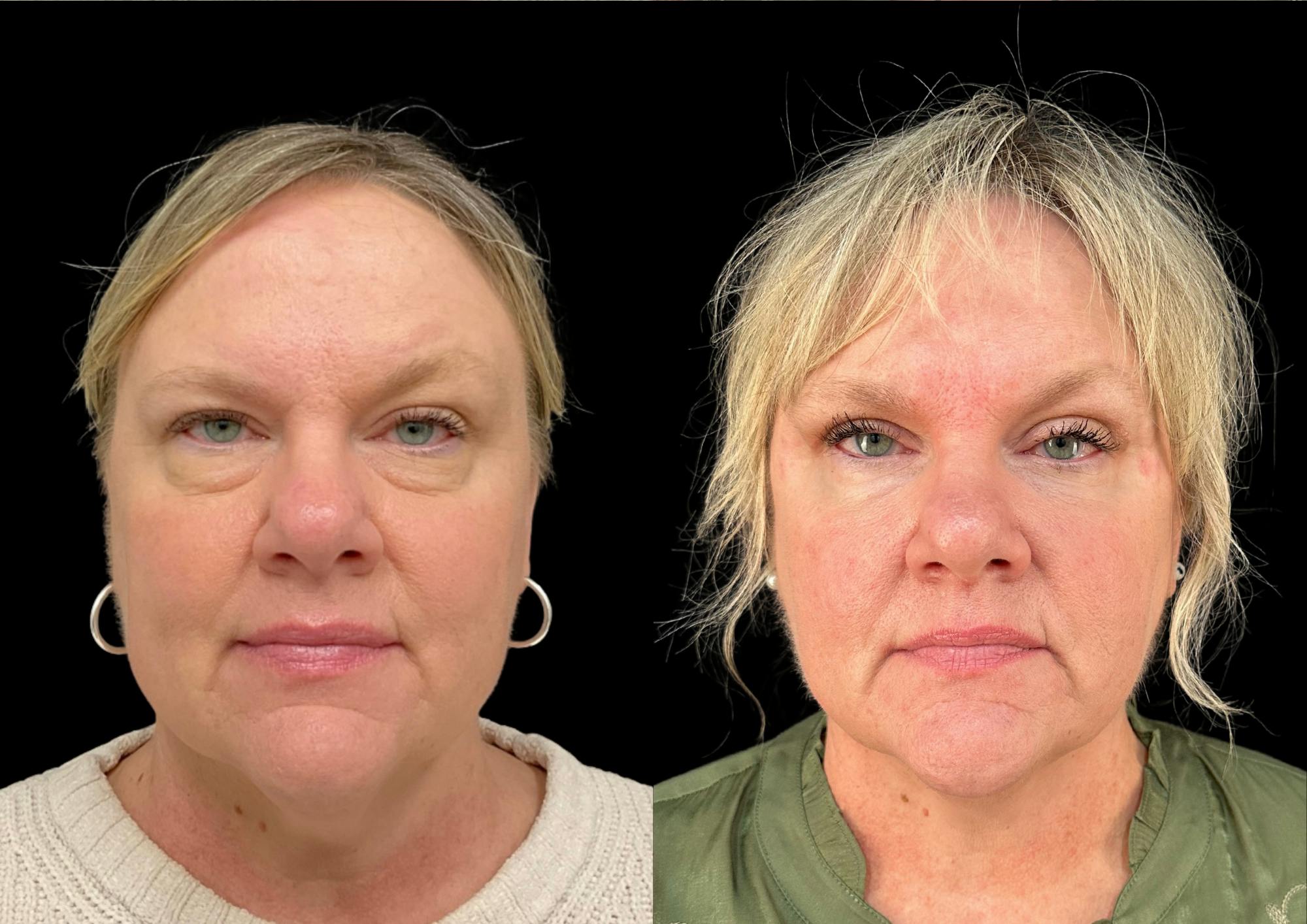 Buccal Fat Reduction Before & After Gallery - Patient 215147 - Image 1