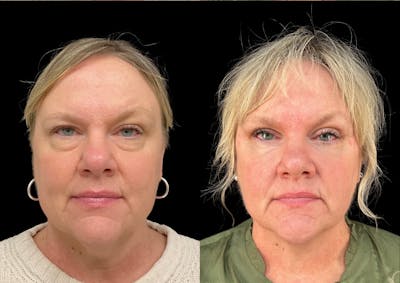 Upper Blepharoplasty Before & After Gallery - Patient 112137 - Image 1
