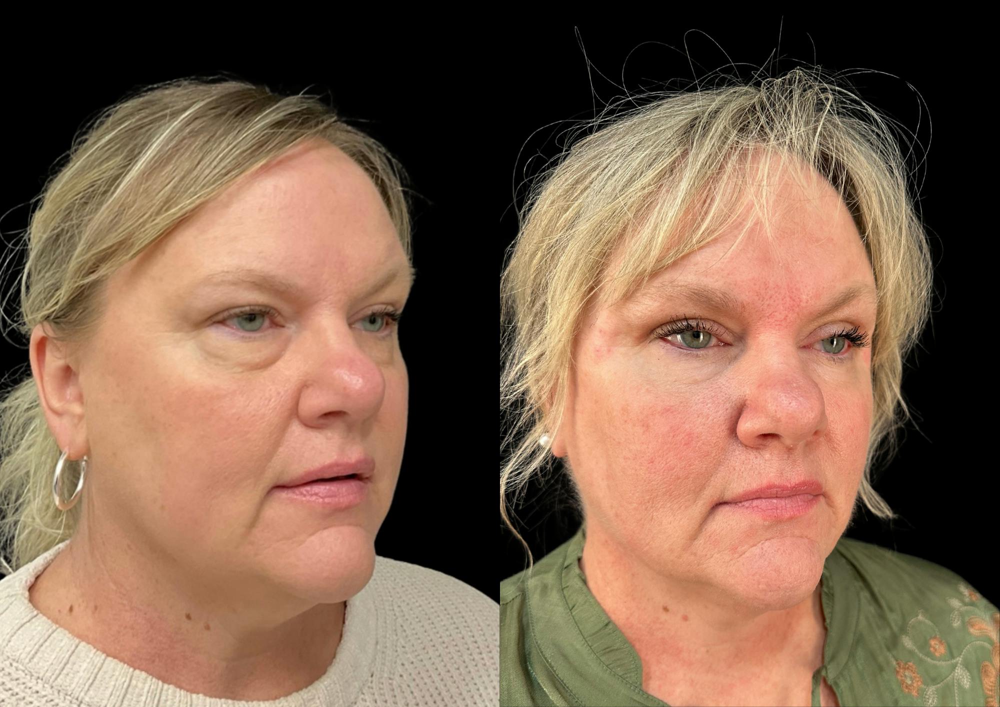 Buccal Fat Reduction Before & After Gallery - Patient 215147 - Image 3
