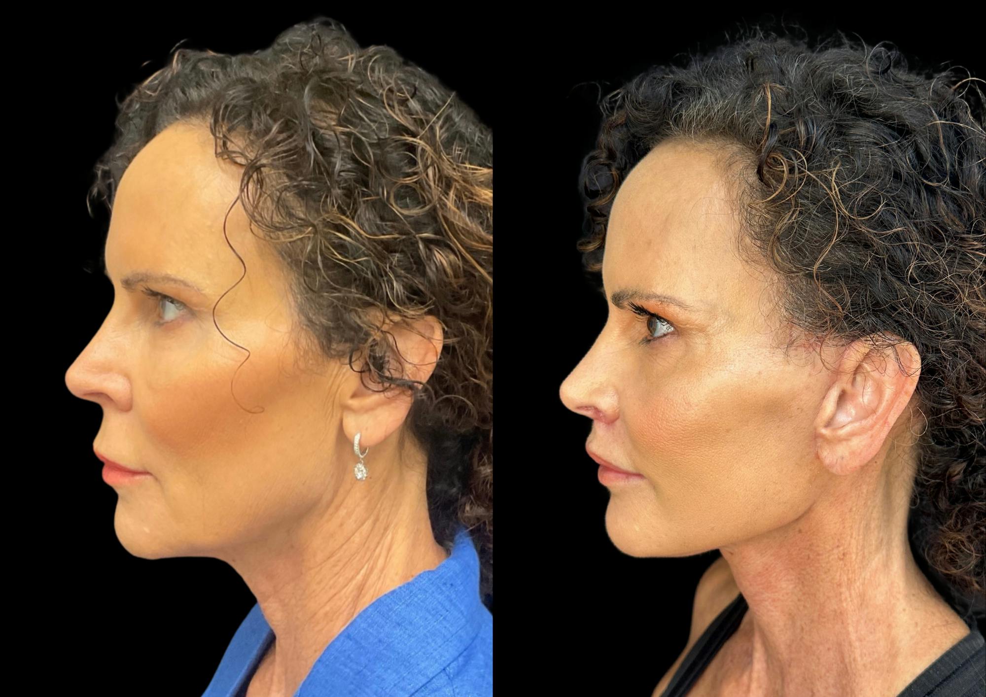 Lip Lift Before & After Gallery - Patient 302573 - Image 3