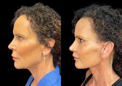 Neck Lift Before & After Gallery - Patient 138122 - Image 1