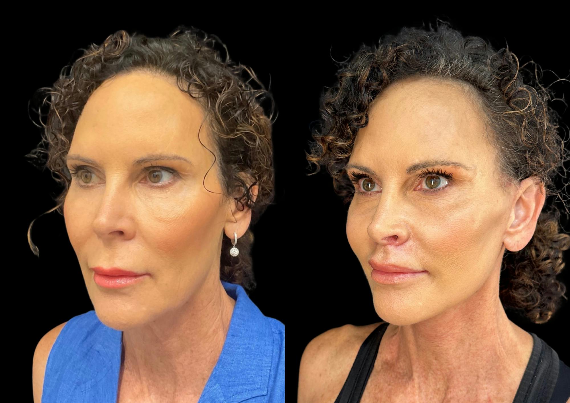 Lip Lift Before & After Gallery - Patient 302573 - Image 2