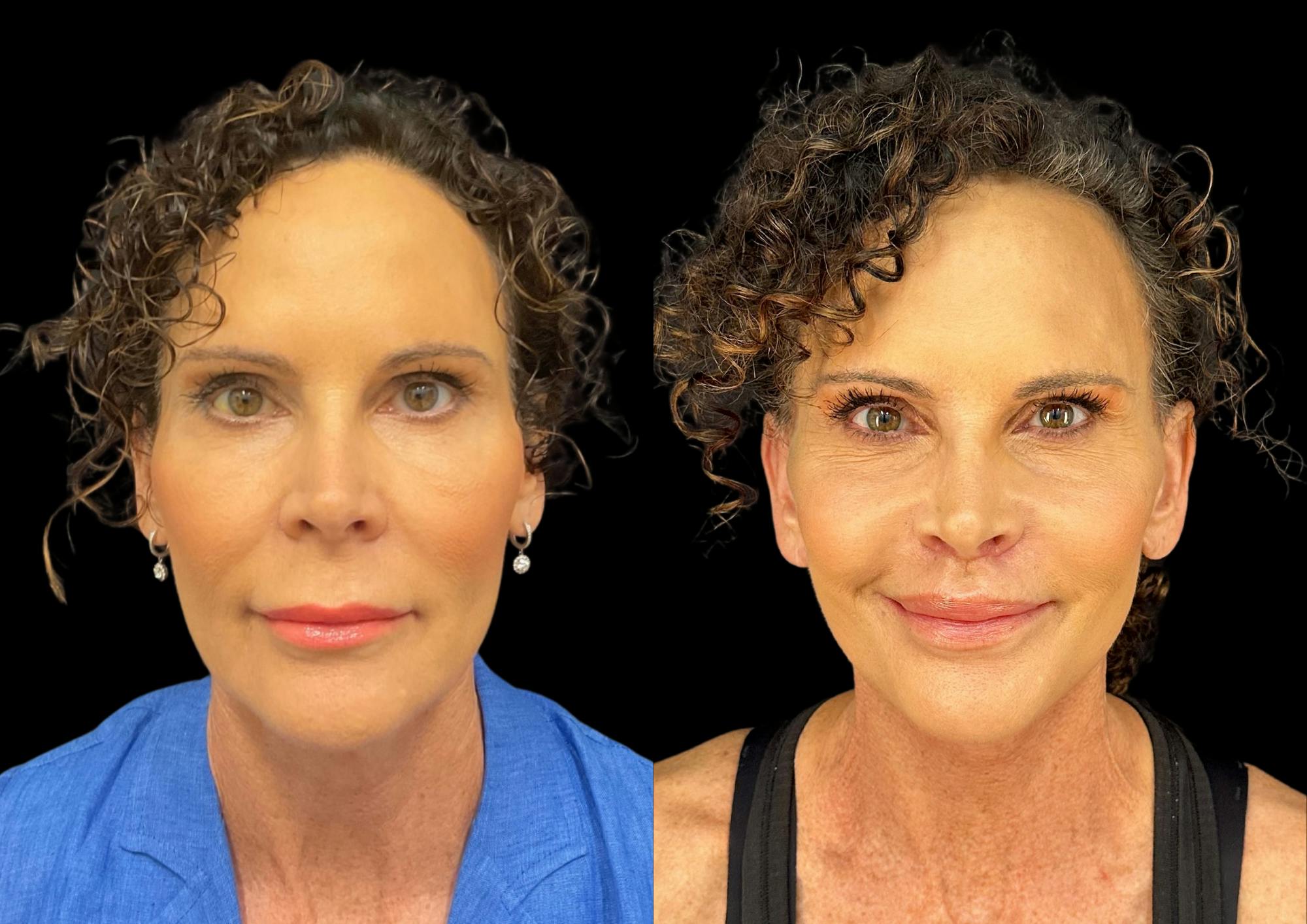 Lip Lift Before & After Gallery - Patient 302573 - Image 1