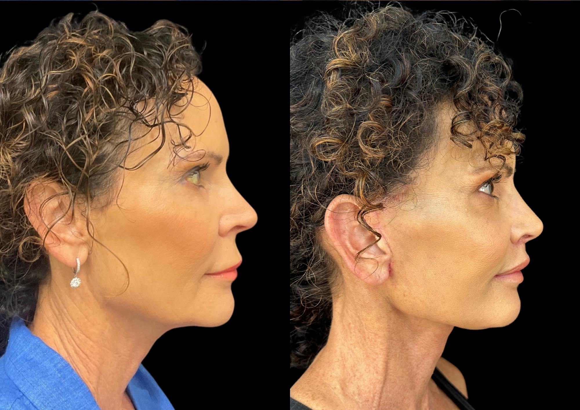 Lip Lift Before & After Gallery - Patient 302573 - Image 5