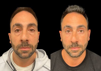Laser Skin Resurfacing Before & After Gallery - Patient 150353 - Image 1