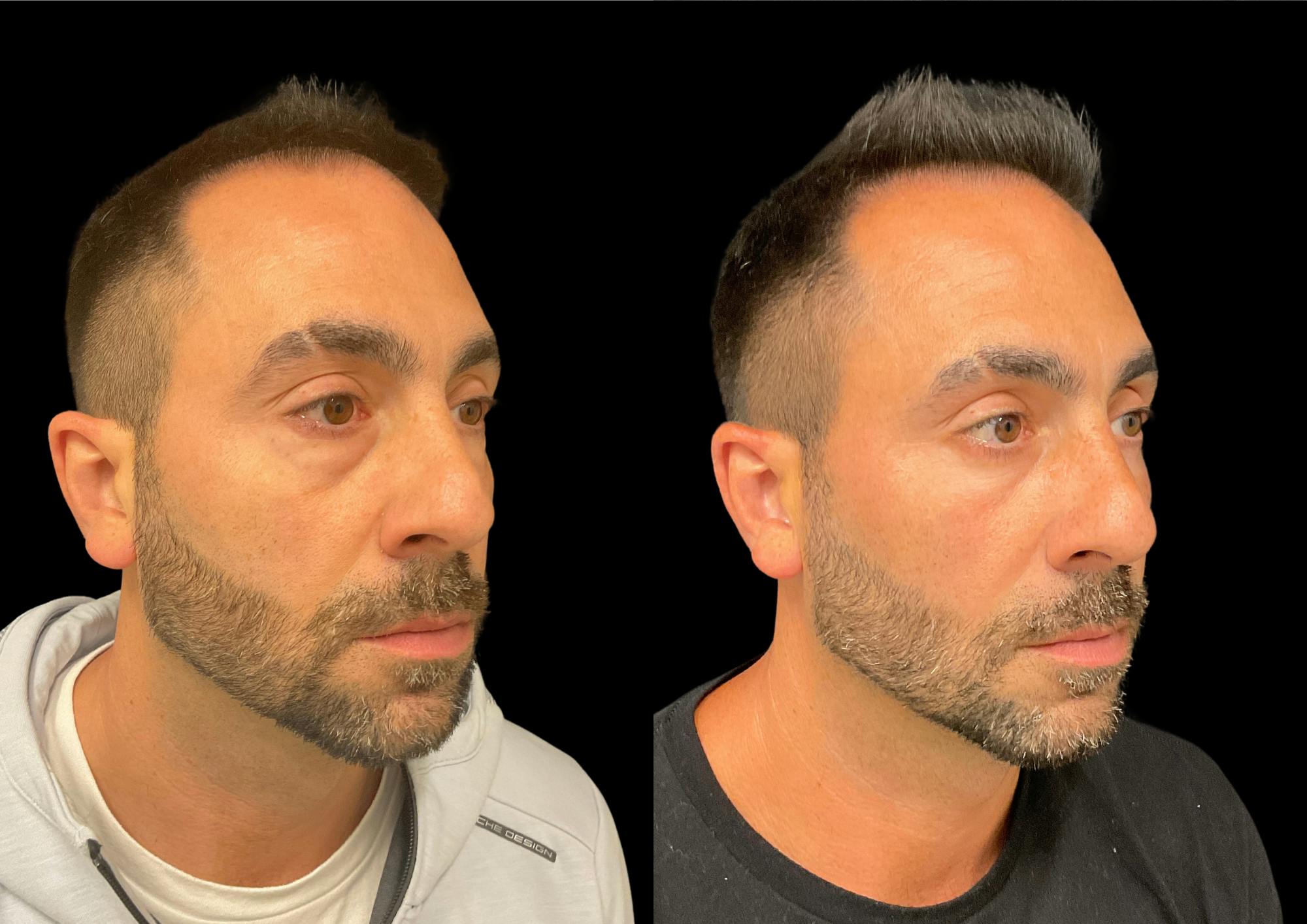 Laser Skin Resurfacing Before & After Gallery - Patient 150353 - Image 3