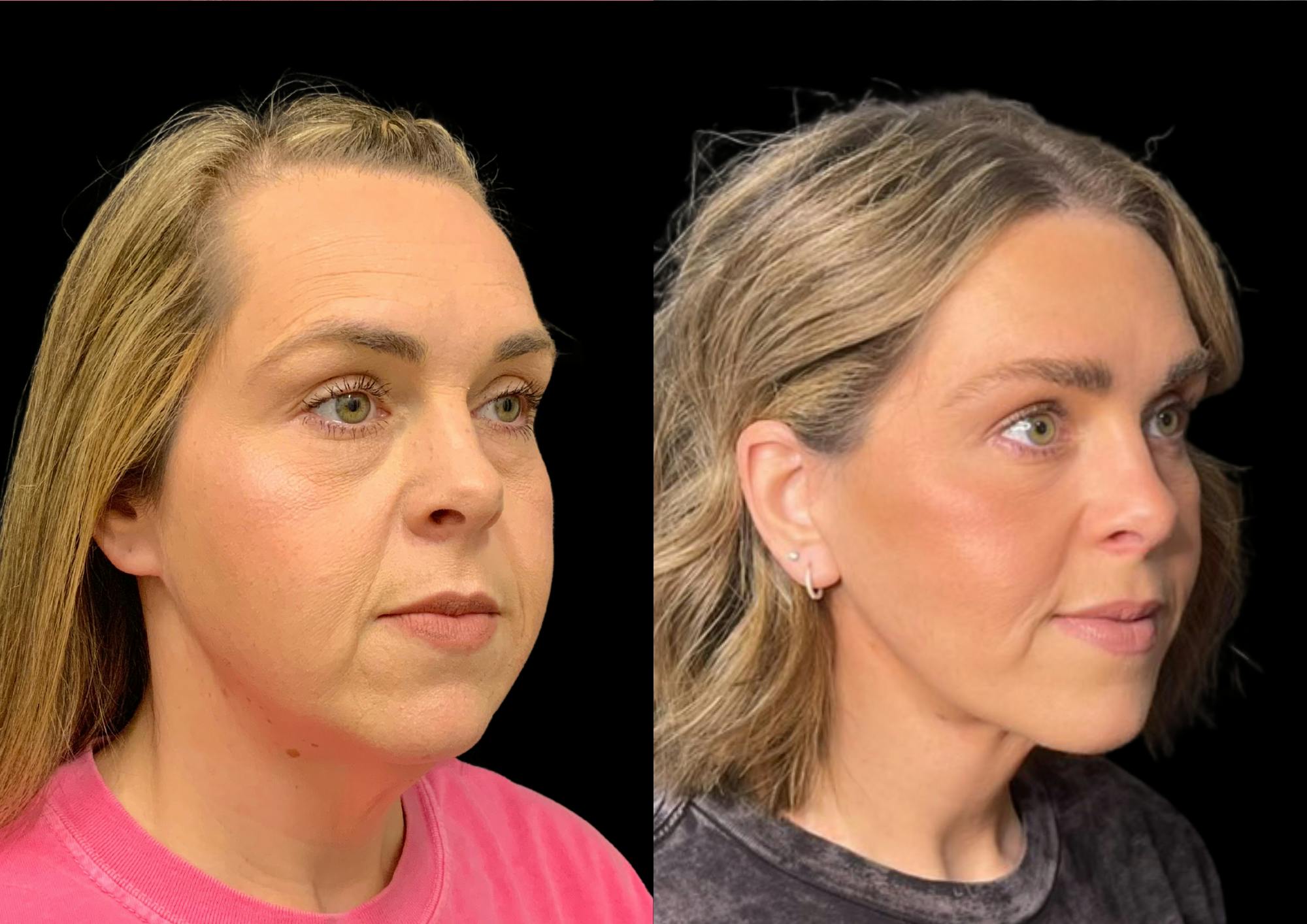 Brow Lift Before & After Gallery - Patient 210636 - Image 5