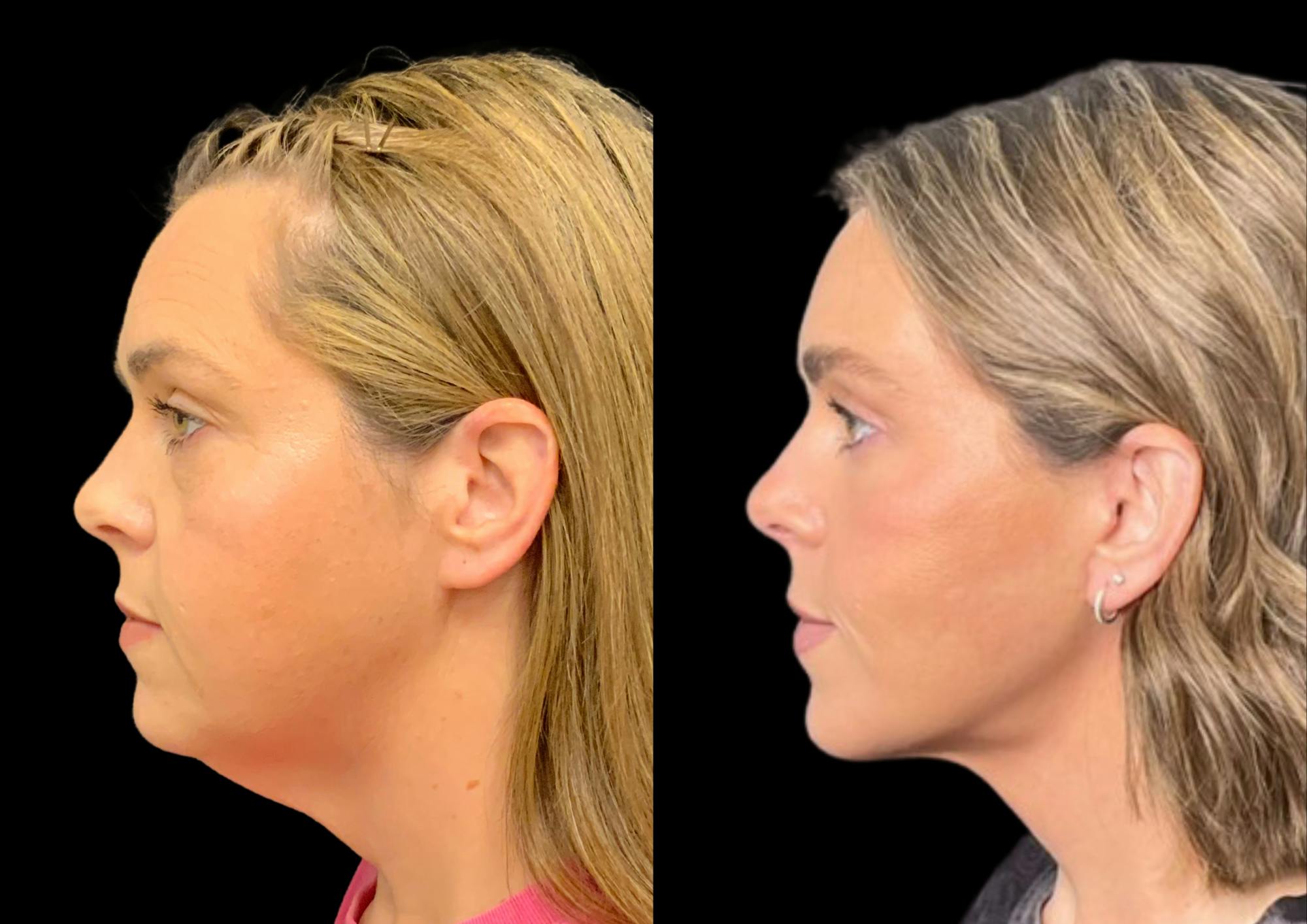 Brow Lift Before & After Gallery - Patient 210636 - Image 3