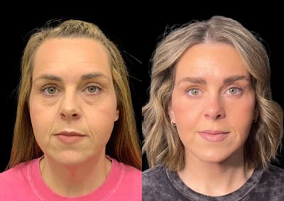 Brow Lift Before & After Gallery - Patient 210636 - Image 1