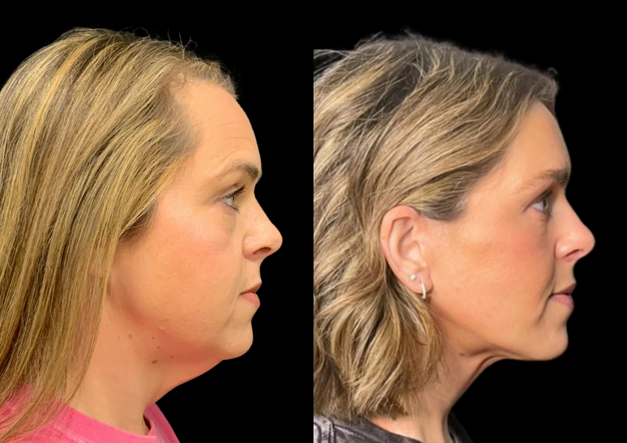 Brow Lift Before & After Gallery - Patient 210636 - Image 6