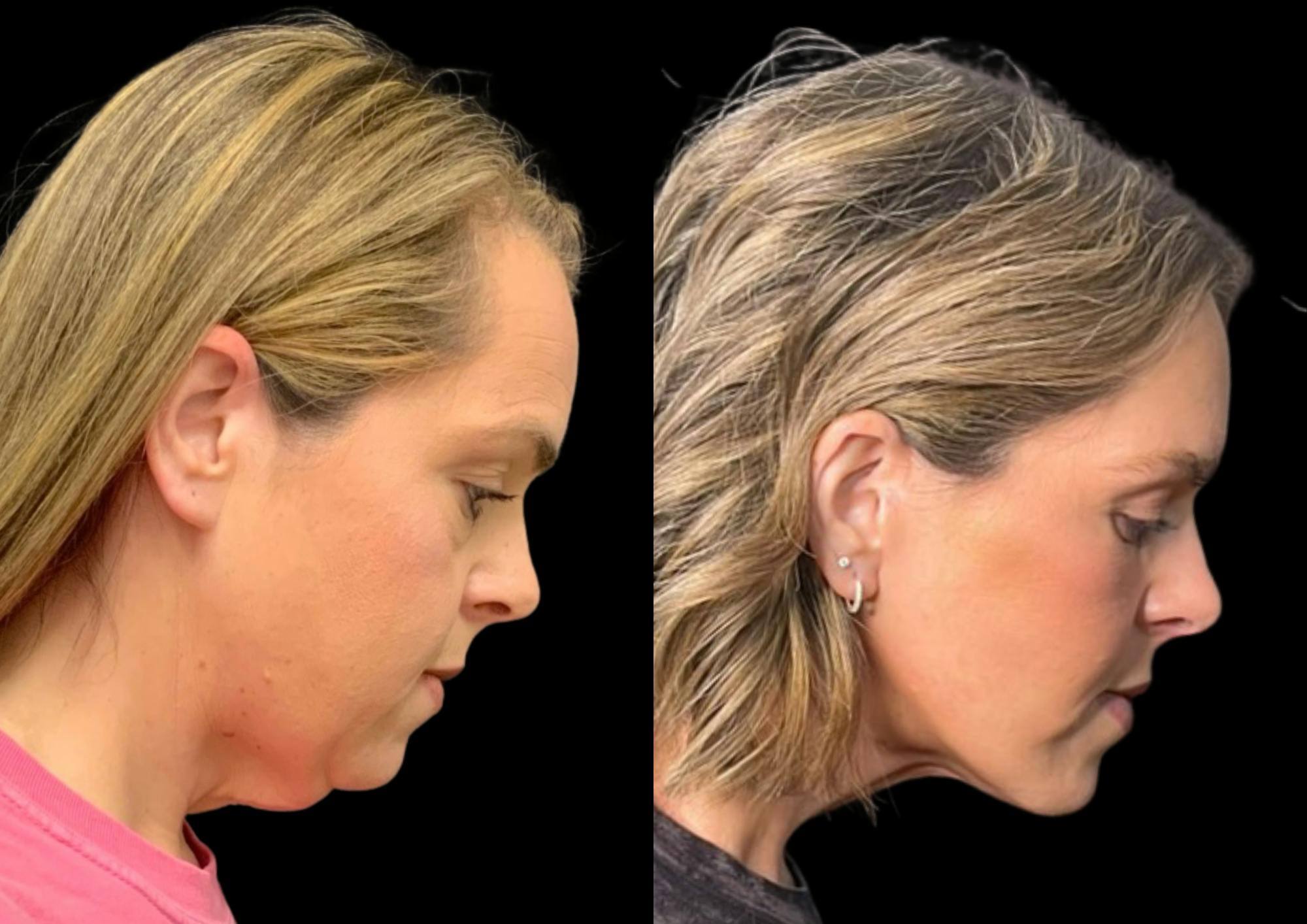 Brow Lift Before & After Gallery - Patient 210636 - Image 7