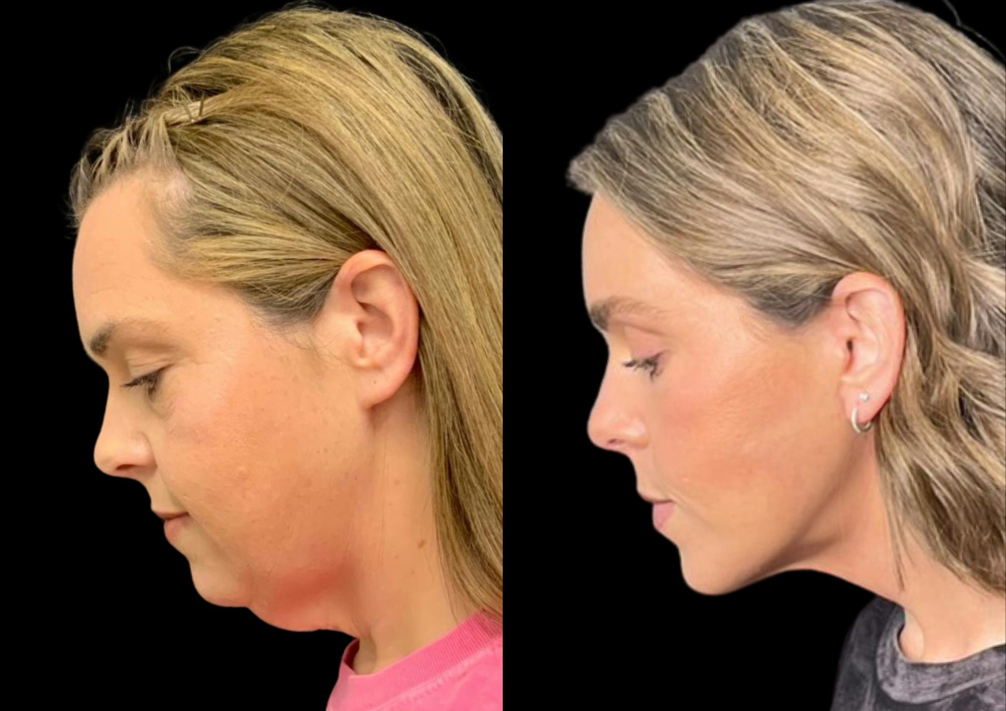 Brow Lift Before & After Gallery - Patient 210636 - Image 4