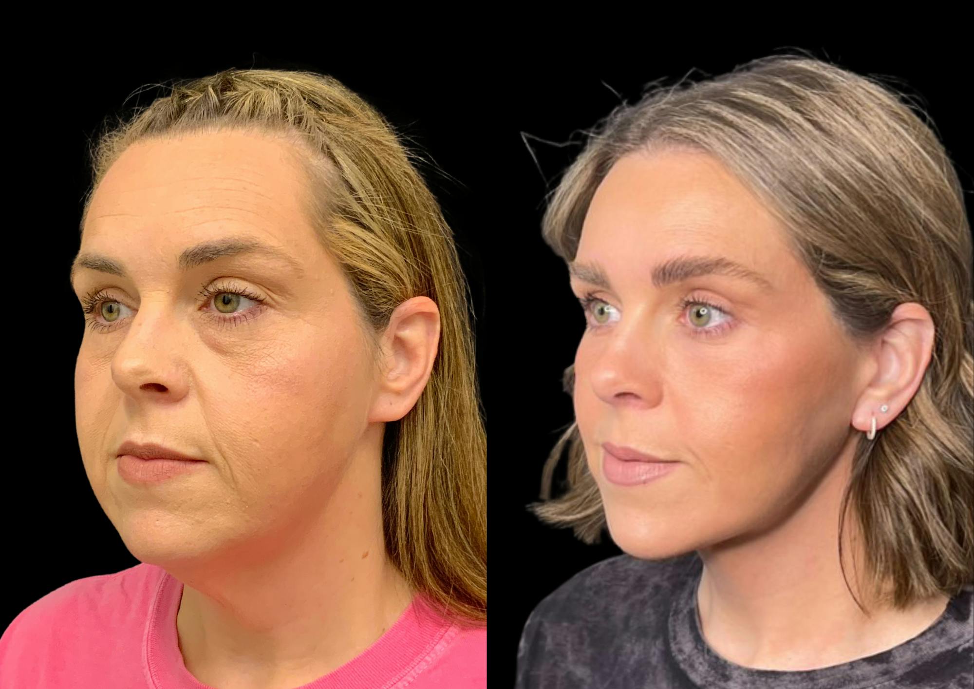 Brow Lift Before & After Gallery - Patient 210636 - Image 2