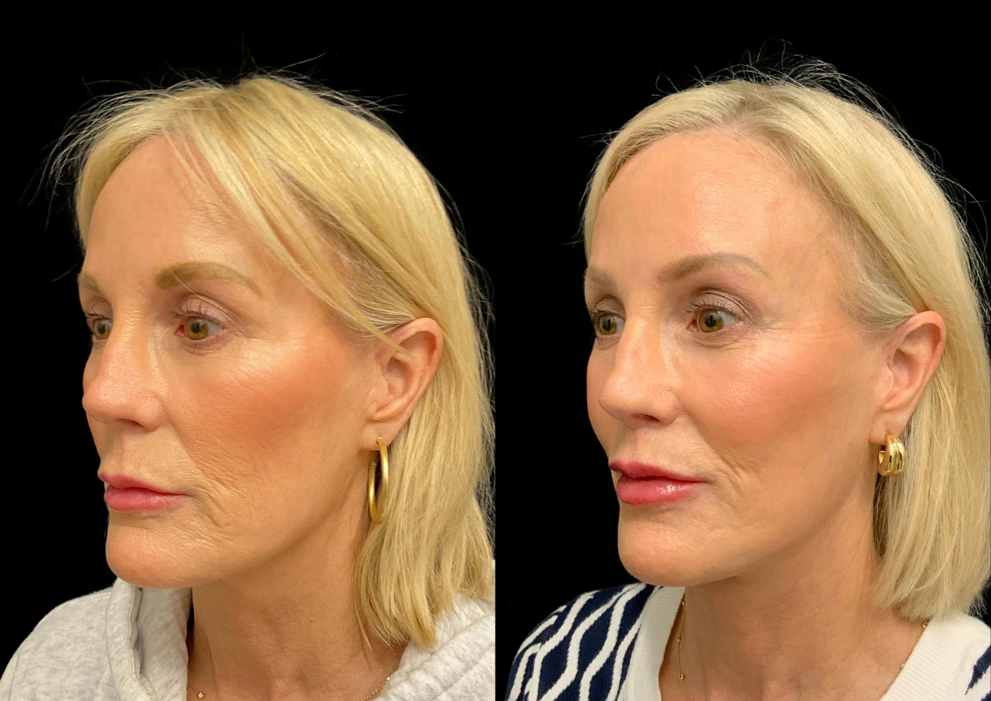 Neck Lift Before & After Gallery - Patient 265142 - Image 2