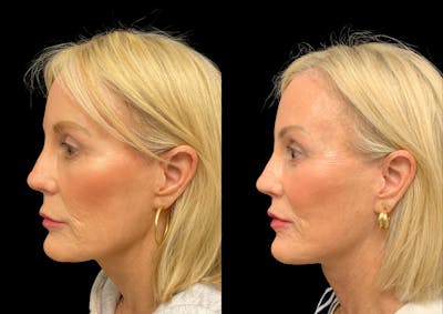 Neck Lift Before & After Gallery - Patient 265142 - Image 1