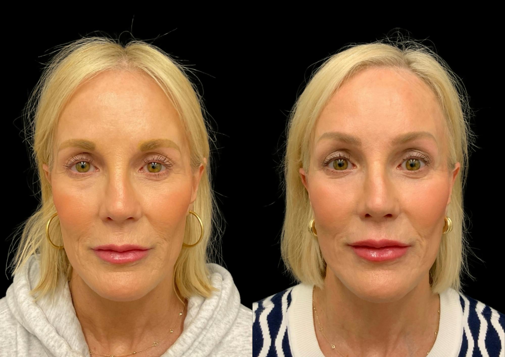 Neck Lift Before & After Gallery - Patient 265142 - Image 3