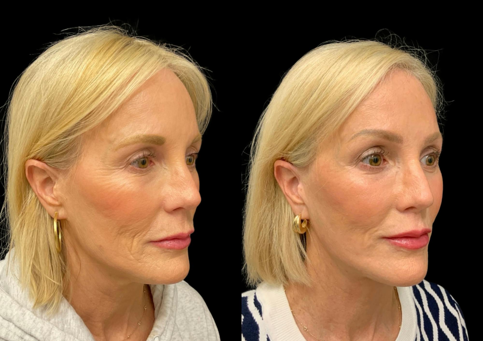 Neck Lift Before & After Gallery - Patient 265142 - Image 4